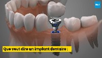 Que veut dire un implant dentaire