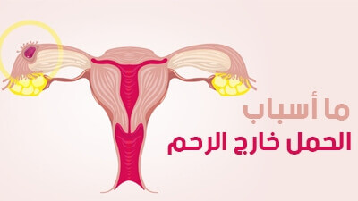 ما أسباب الحمل خارج الرحم
